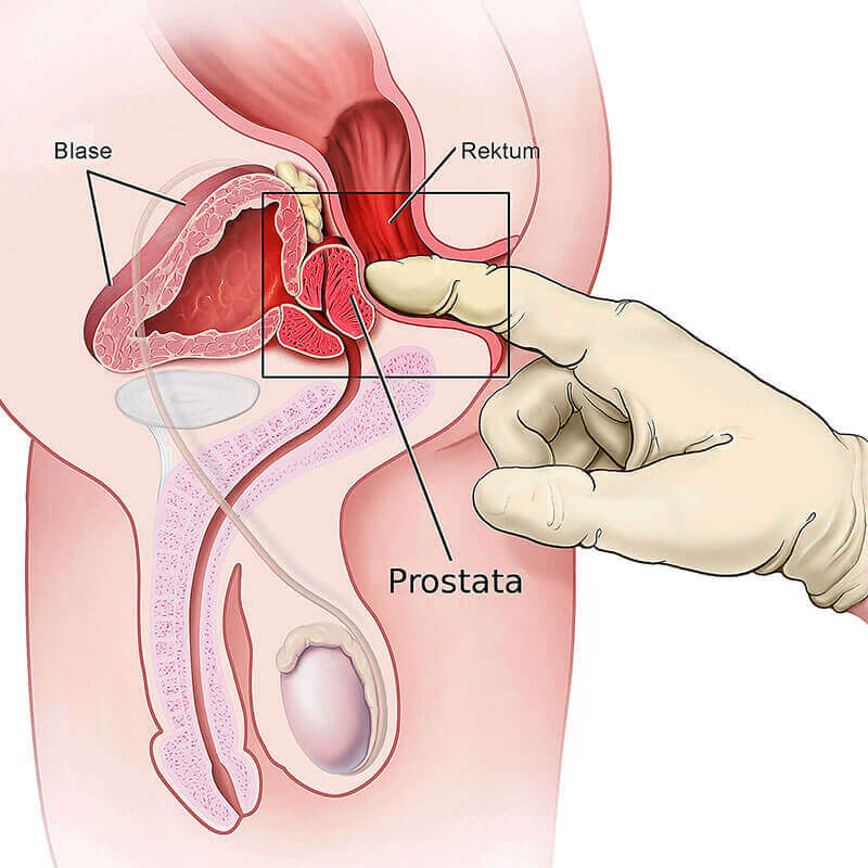 Illustration Prostatakrebs Vorsorgeuntersuchung