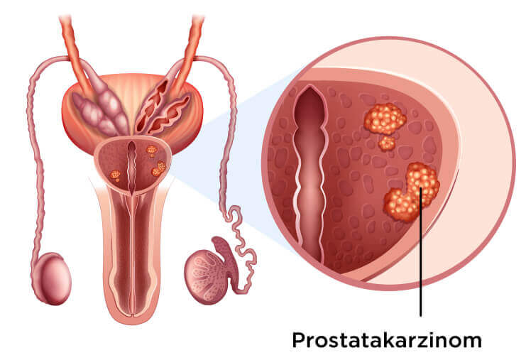 Ihre private Radiologie in Saarbrücken: Prostatakrebs Illustration